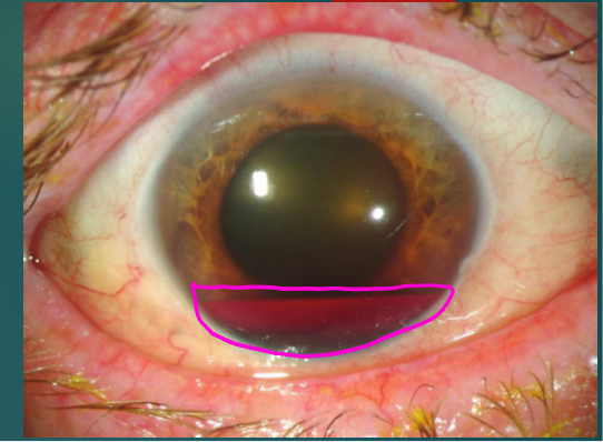 <p>Trauma to the eye- bleeding in anterior chamber</p><p>Stretches limbal vessels and displaces the iris and lens</p><p>-may result in tear of iris or ciliary body causing bleeding</p><p>Blood exits anterior chamber via trabecular meshwork and Schlemm canal. Blood clots form blocking exit causing hyphema and increased IOP</p><p>Males are involved in ¾ of cases</p><p>Spontaneous hyphema are secondary to neovascularization (DM, ischemia), ocular neoplasms (retinoblastoma) and vascular anomalies</p>