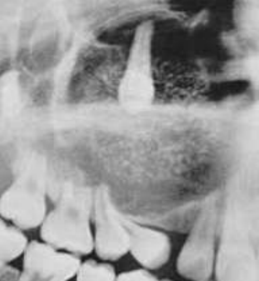 <p>• Well circumscribed, corticated</p><p>• Unilocular or multilocular</p><p>• Associated with unerupted tooth</p><p>• Mixed radiodensity</p><p>• Displacement of adjacent teeth</p>