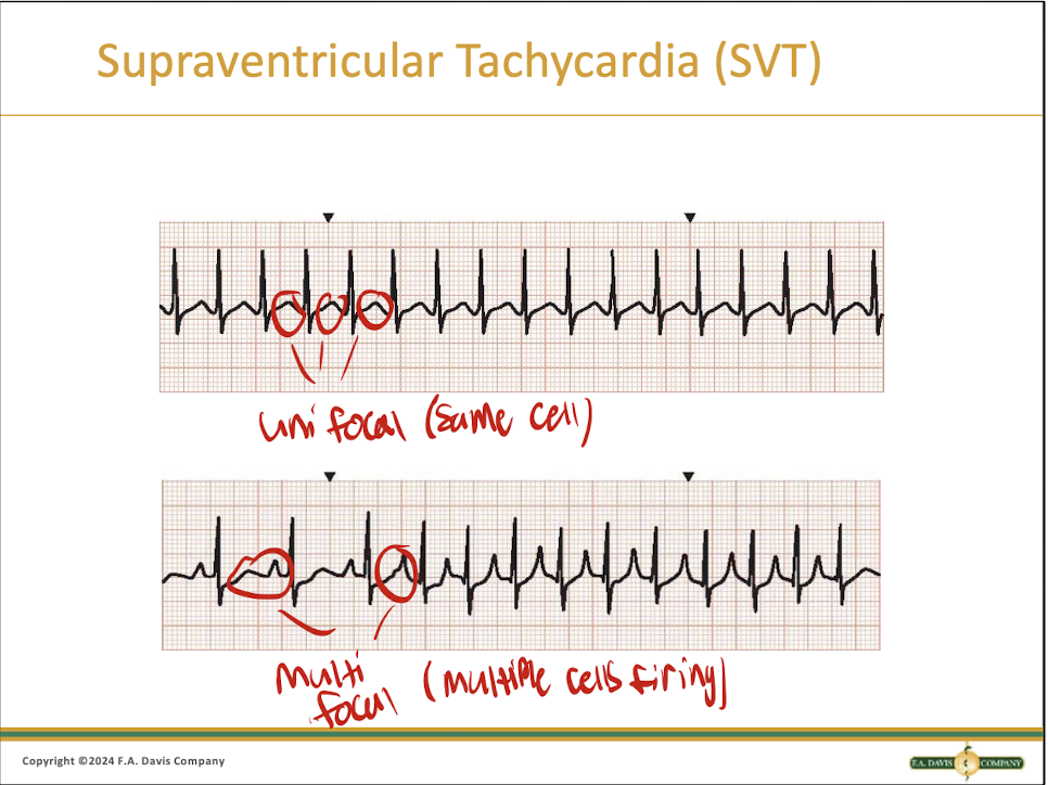 <p>Narrow QRS complex with a continuous fast heart rate, often the P wave is absent </p>