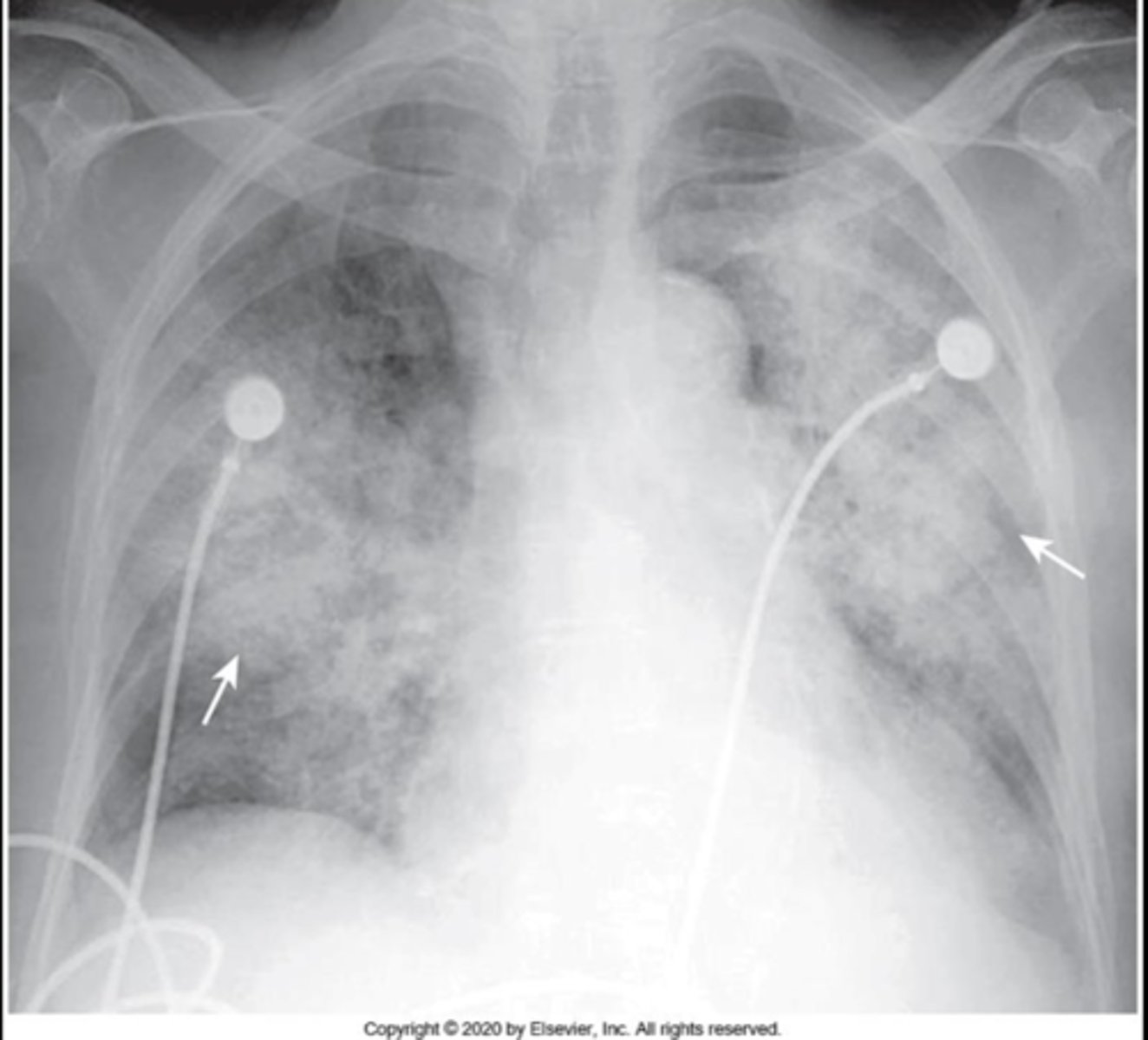 <p>Do you see a alveolar or interstitial pattern here?</p>