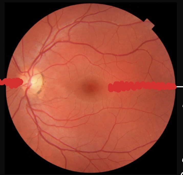 <p><u>Posterior Chamber</u></p><p><strong>Retina</strong></p><p>Label the optic disc and the fovea and describe their function</p>