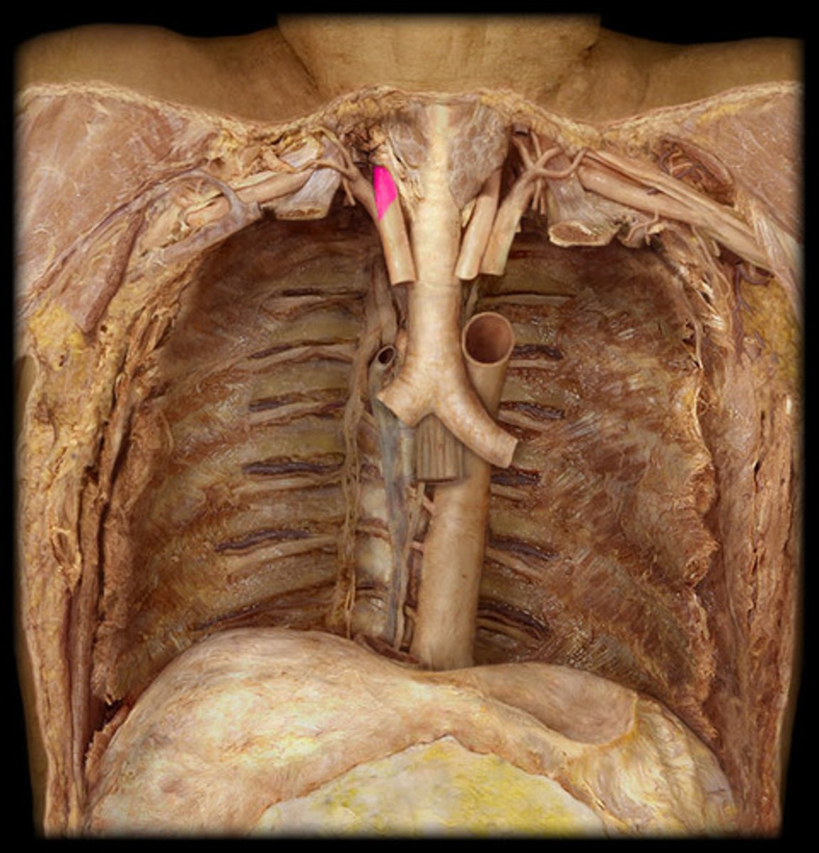 <p>supplies blood to neck and head on right side</p>