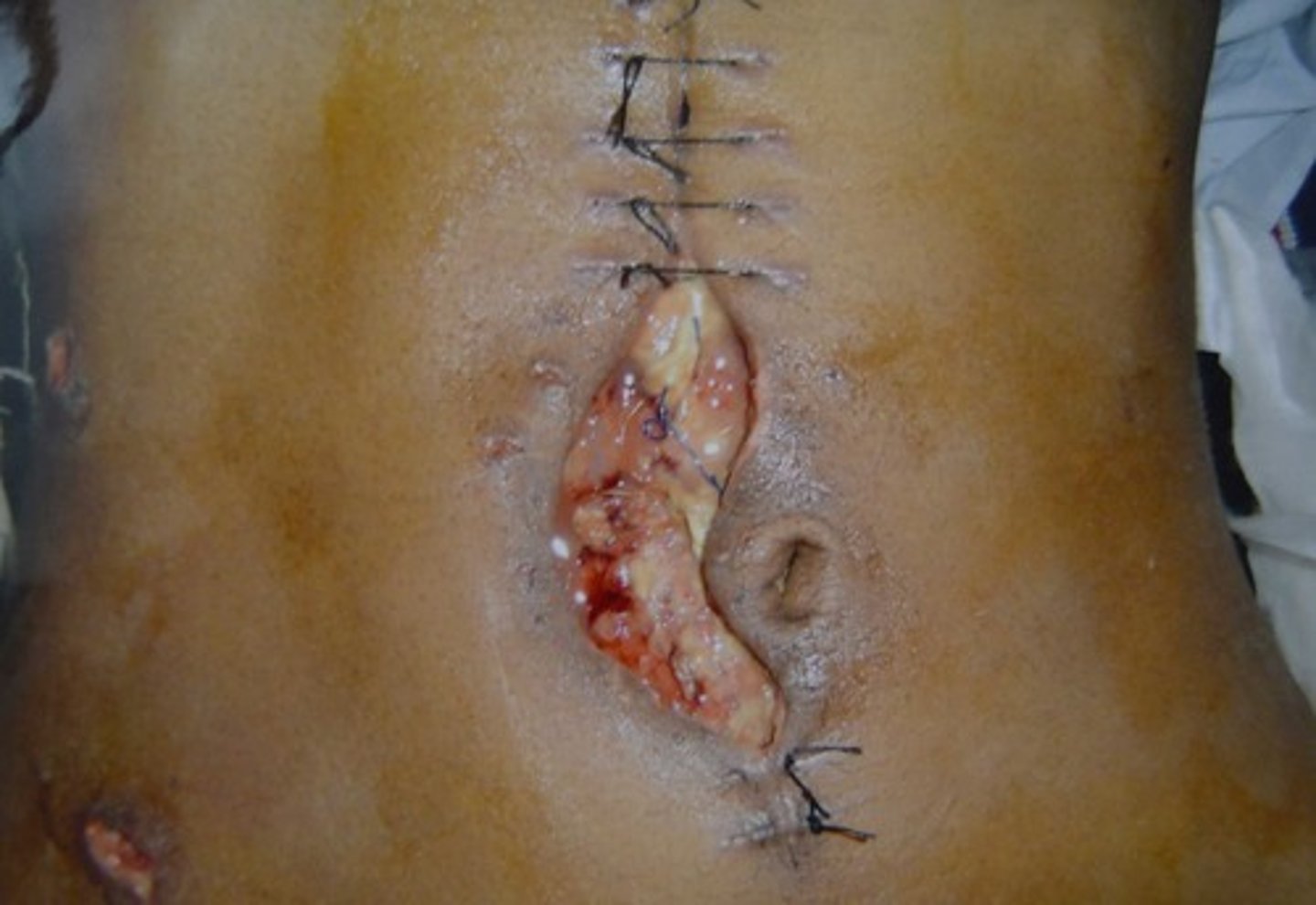 <p>A surgical complication in which a wound ruptures along surgical suture.</p>