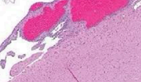 <p>Cystic rupture filled with blood</p>