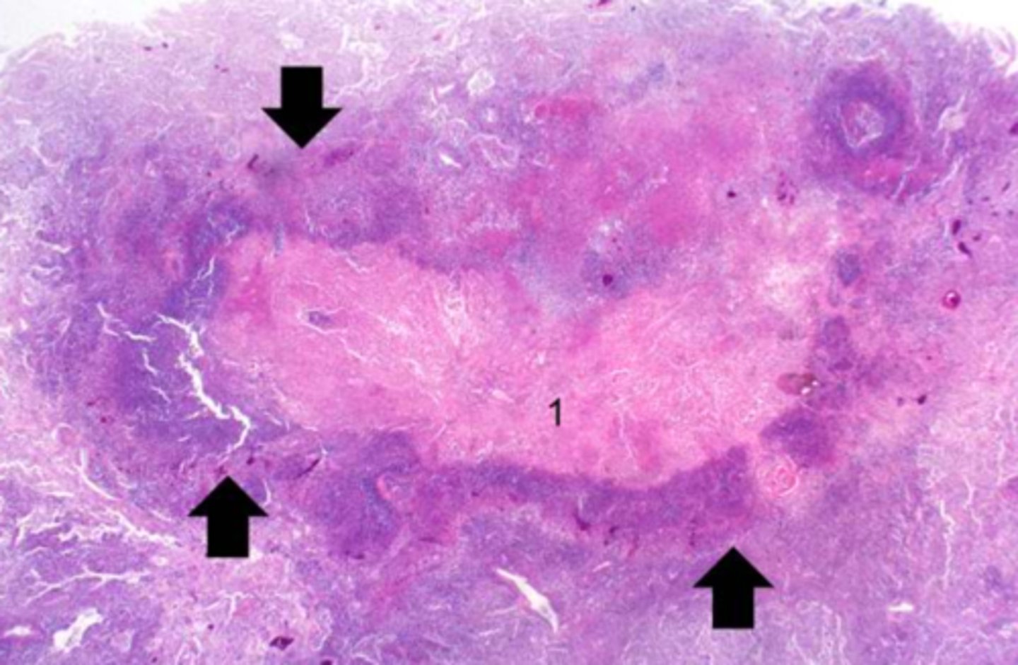 <p>- "Vast pink wasteland", sometimes surrounded by a blue rim of infiltrating inflammatory cells (necrosis is pro-inflammatory)</p>