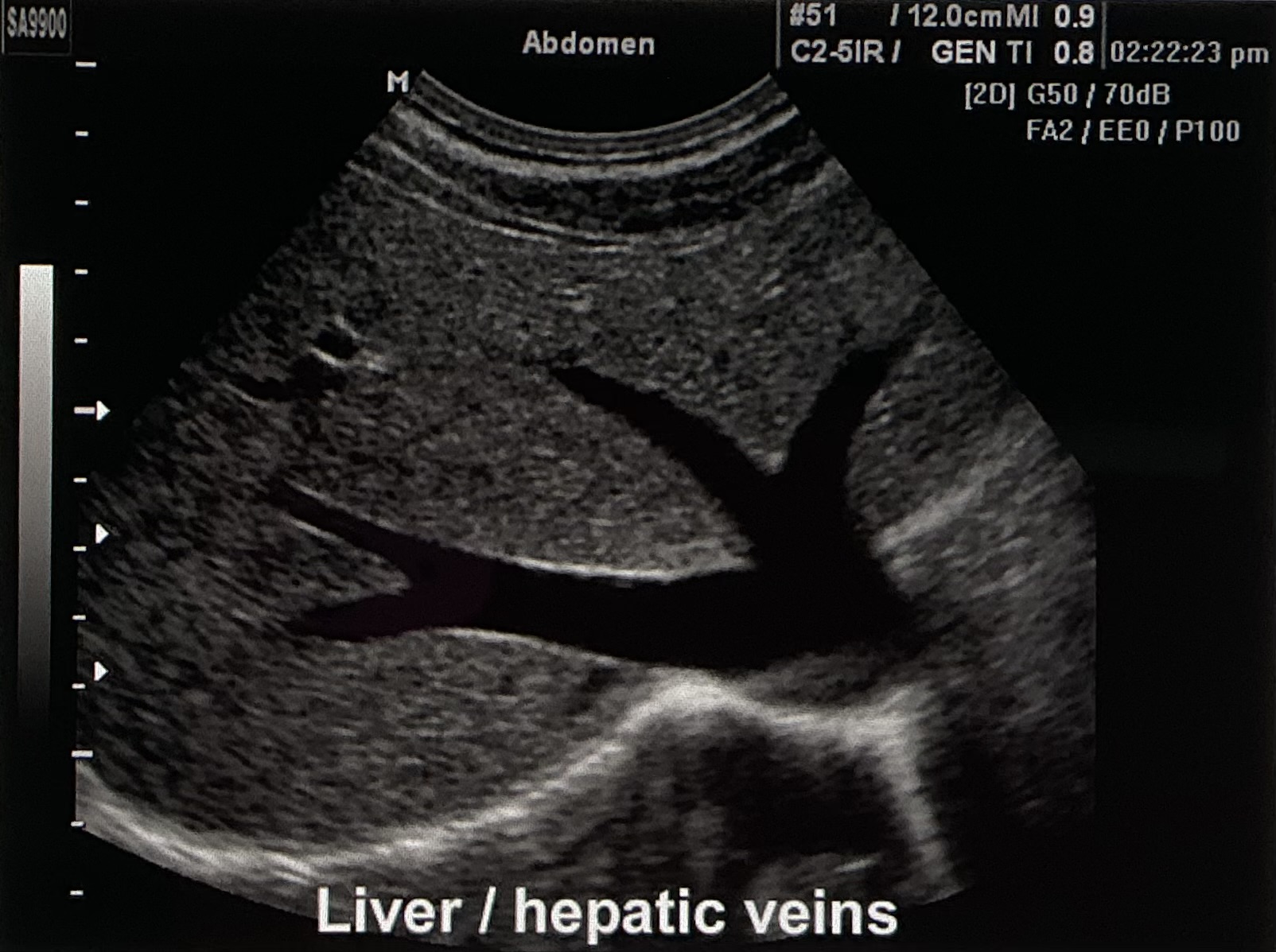<p>Describe the sonographic appearance of this image.</p>