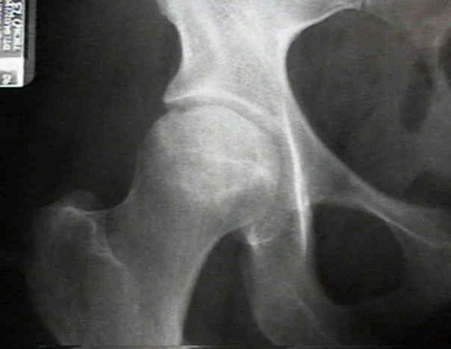 <p><strong>_______________</strong> of the hip</p><p>- Femoral head is flattened, irregular and sclerotic</p><p>- <strong>Crescent sign</strong> may be seen</p><p>Best study is an MRI</p><p></p><p>(**Steroid use, EtOH abuse...)</p>