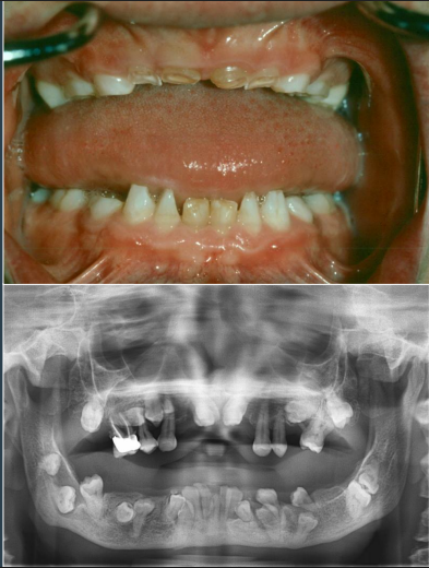 <ul><li><p>prolonged retention of teeth </p></li><li><p>delay or failure of eruption of permanent teeth </p></li><li><p>supernumerary teeth </p></li><li><p>numerous unerupted permanent and supernumerary teeth </p></li></ul><p></p>