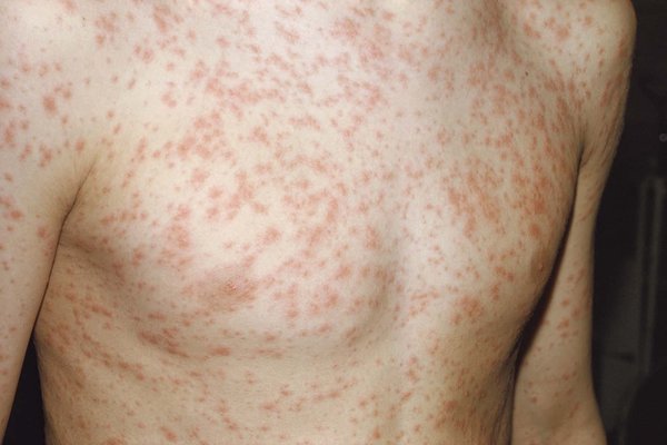 <ol><li><p>light skin - rash appears pink or red-spotted, rough, and bumpy</p></li><li><p>dark skin - rash may appear hyperpigmented and rough/bumpy</p></li></ol><p></p>