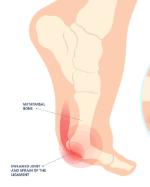 <p>forceful hyperextension of big toe</p>