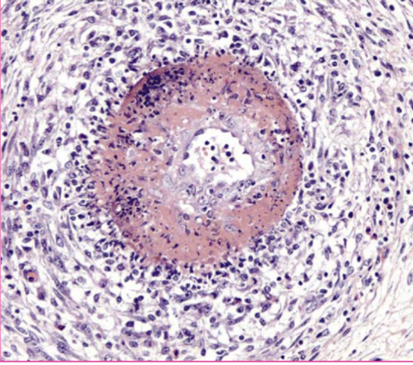 <p>What type of necrosis?</p>
