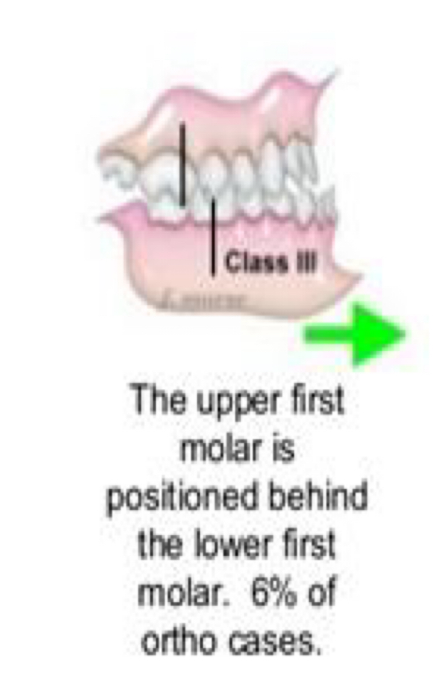 <p>Mandibular teeth positioned forward relative to maxillary </p>