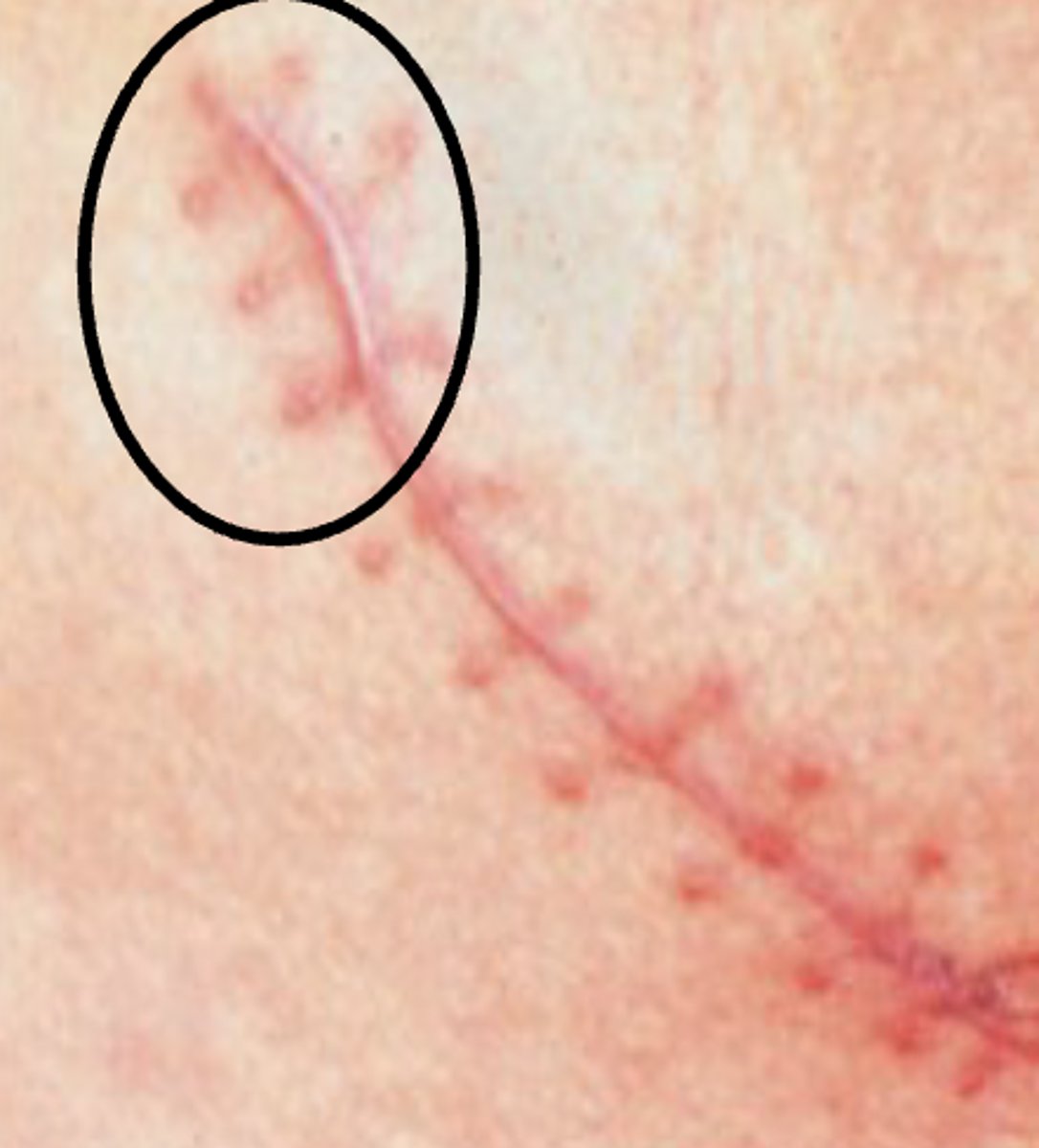 <p>Raised at site of original wound, but maintains borders</p><p>- Reddish, sometimes itchy</p><p>- Caused by too much stress on scar early on</p><p>- Body makes more scar tissue, but nowhere to go but up</p>