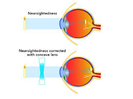 <p>How is <strong>myopia</strong> (nearsightedness) corrected?</p>