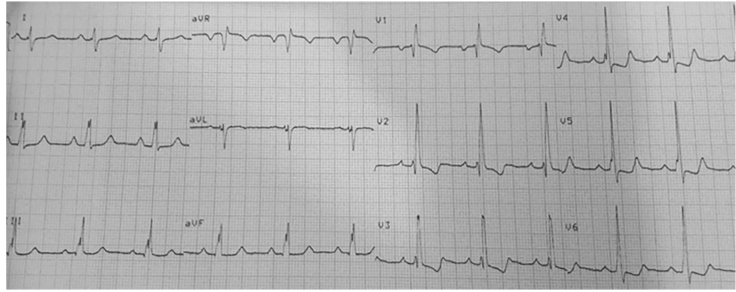<p>What might you see on EKG for ASD?</p>