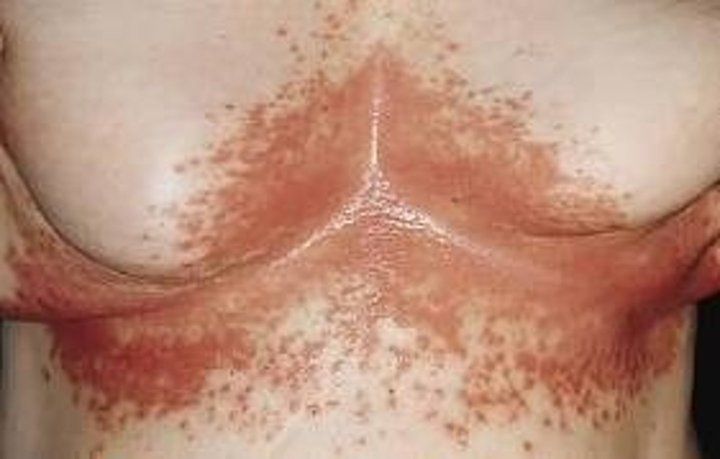 <p>candida infection in the intertriginous areas (two skin surfaces rub together)</p><p>rash begins with vesiculopustules which rupture, causing maceration</p><p>lesions coalesce and satellite lesions are visible near the margins</p>