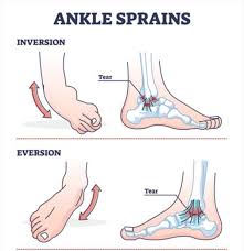 <p><span>Turning foot inward at the ankle.</span></p>