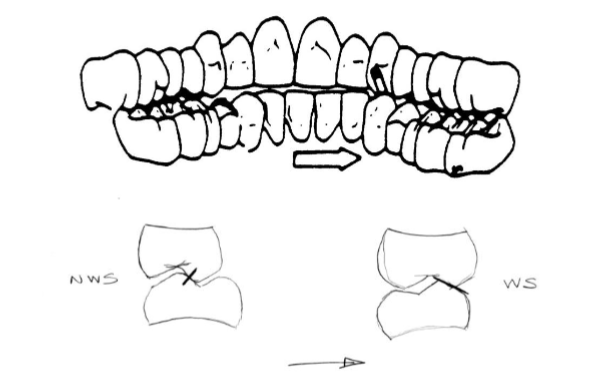 <p>Which type of occlusion </p>