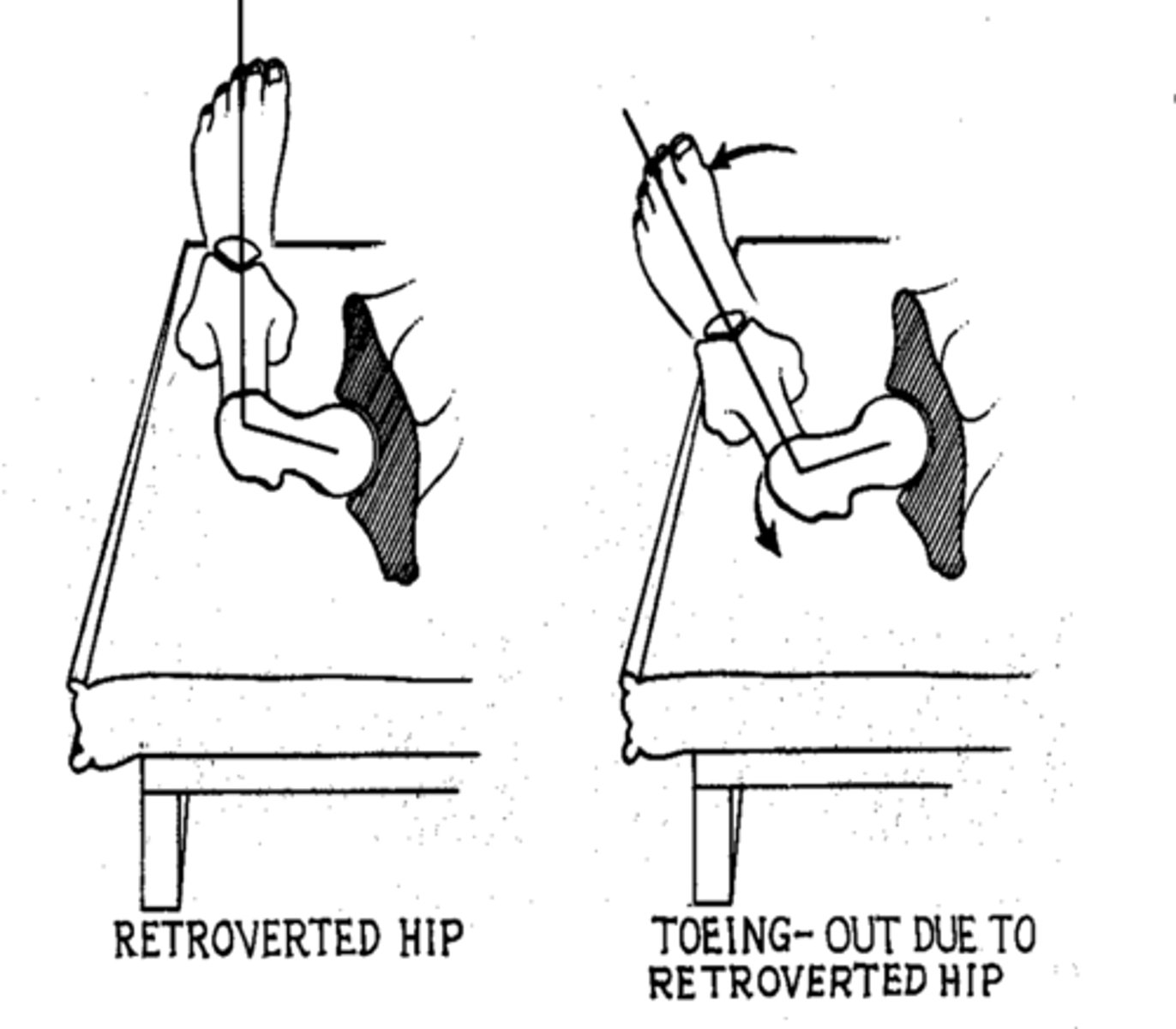 <p>angle of torsion is less than 8 degrees</p><p>lacks IR</p><p>toe-out gait</p>