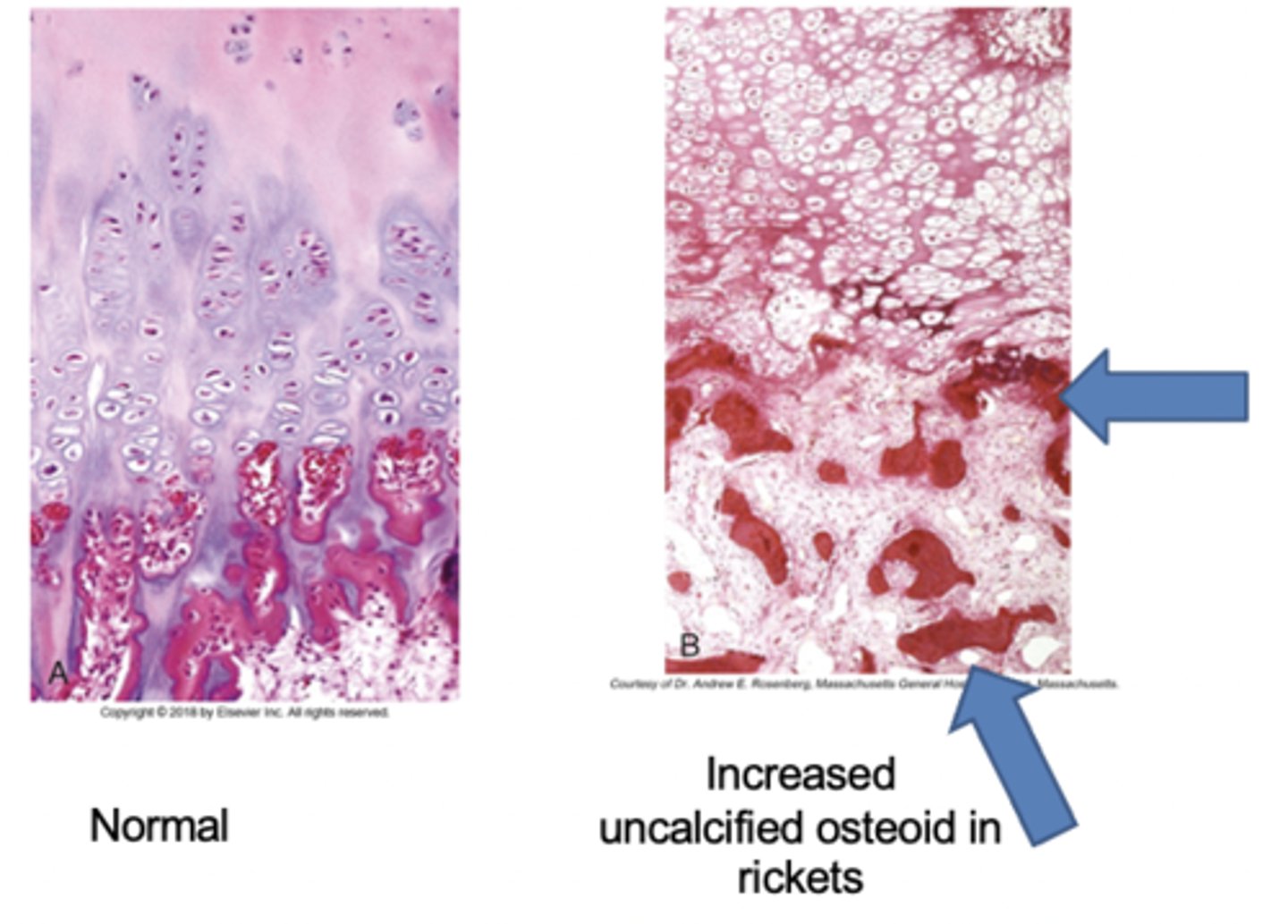 <p>- Normal (L): costochondral junction of a young child illustrates formation of cartilage pallisades and orderly transition from cartilage to new bone</p><p>- Rickets (R): Detail of rachitic costochondral junction in which the <strong>palisades of cartilage is lost</strong>; darker trabeculae are well-formed bone; paler trabeculae consist of uncalcified osteoid</p>