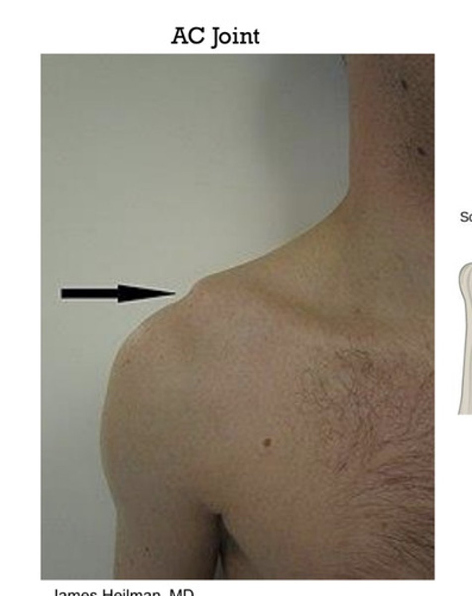 <p>between the lateral end of the clavicle and the acromion process of the scapula</p>