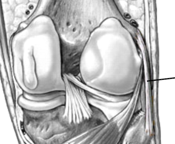 <p>Which ligament of the knee:</p><ul><li><p>Extends from the lateral epicondyle of the femur to the head of the fibula</p></li><li><p>Located on the lateral side of the knee joint</p></li></ul><p></p>