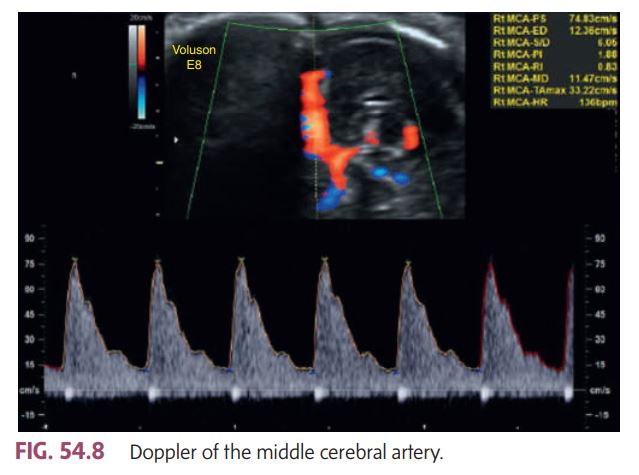 <p></p><ul><li><p>The <strong>waveform</strong> pattern looks normal — sharp systolic peaks with clear forward diastolic flow.</p></li><li><p>The <strong>peak systolic velocity (PSV)</strong> shown in the image is <strong>74.83 cm/s</strong>, which is <strong>within the normal range</strong> for most gestational ages.</p></li><li><p>According to book: a <strong>PSV greater than 1.5 multiples of the median (MoM)</strong> suggests <strong>severe fetal anemia</strong>. Since this velocity does <strong>not exceed</strong> that threshold, it indicates <strong>no evidence of fetal anemia</strong>.</p></li></ul><p><br>This MCA Doppler image demonstrates a __________</p>
