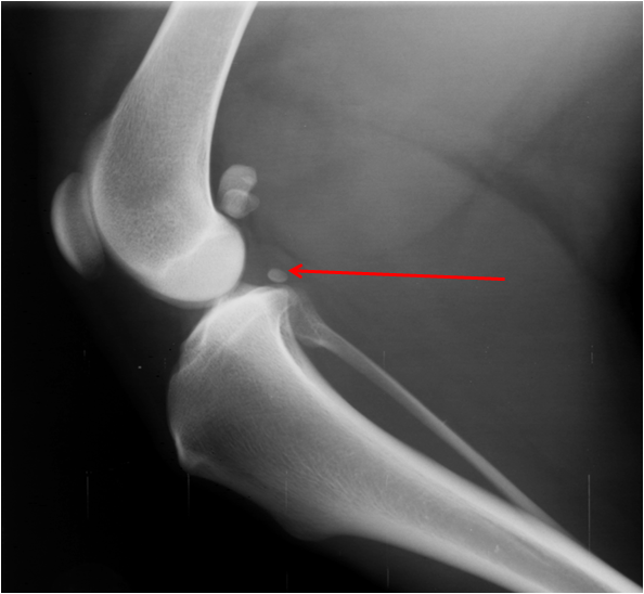 <p>this is a sesamoid bone in the tendon of which muscle?</p>
