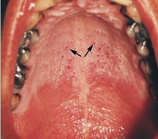 <ul><li><p>lesion associated with salivary glands</p></li><li><p>hard palate whitened by hyperkeratinization due to heat from tobacco use or hot liquid consumption</p></li></ul><p></p>