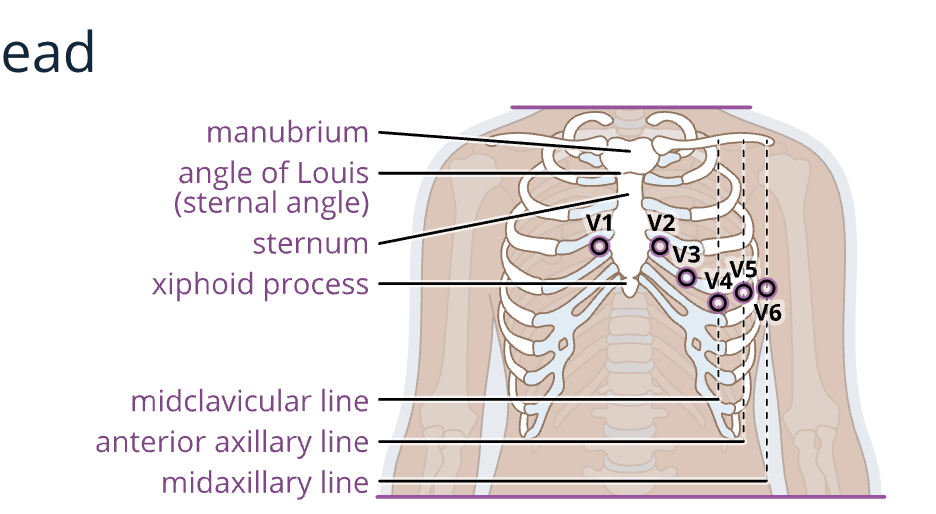<p> white: right arm, 2-3 inches below the clavicle<br>black: left arm, 2-3 inches below the clavicle<br>red: left leg, above the ankle<br>green: right leg, above the ankle<br>brown: V1, 4th intercostal space, right of sternum<br>orange: V2, 4th intercostal space, left of sternum<br>yellow: V3, midway between V2 and V4<br>purple: V4, 5th intercostal space, left midclavicular line<br>pink: V5, left anterior axillary line, same level as V4<br>light blue: V6, left midaxillary line, same level as V4. </p>