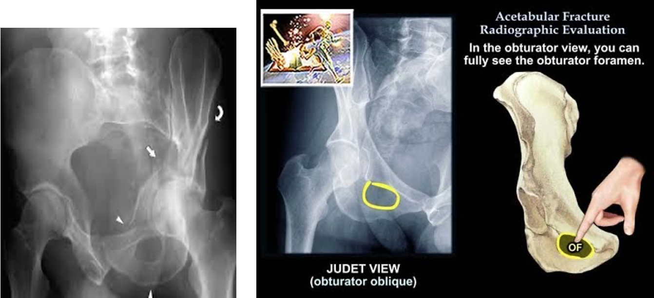 <p>posterior wall of acetabulum</p>