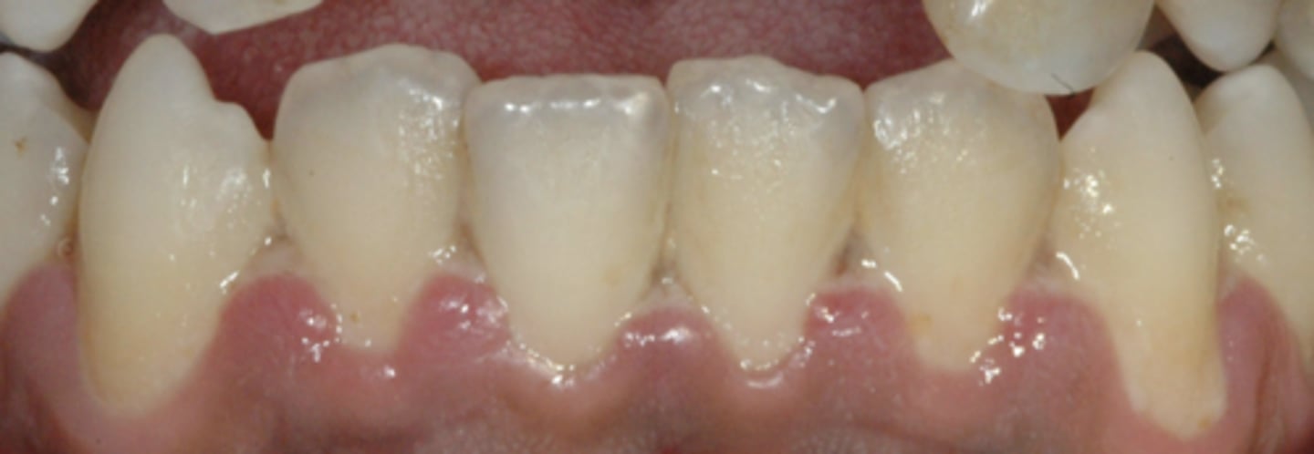 <p>Painful, bleeding gums, and ulceration of inter-dental papillae</p>