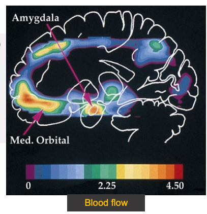 <p>Increased activity (blood flow) of emotional orbitofrontal cortex and amygdala.<br><br>Decreased activity of areas involving attention and language.</p>
