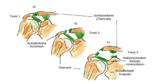 <p><strong>Tossy 1</strong>: Auseinanderweichen Schlüsselbein, Schulterhöhe um halbe Schaftbreite, keine wesentliche Bandverletzung</p><p><strong>Tossy 2</strong> : Auseinanderweichen um Schaftbreite, Zerreißung schultereckgelenk-Band</p><p><strong>Tossy 3 </strong>: Zerreißung aller Bandstrukturen</p>