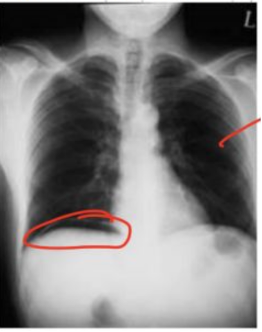 <p><span>Masculino de 43 años con antecedentes de importancia: colecistectomía laparoscópica hace 5 días, se presenta a la emergencia por dolor abdominal moderado de 4 horas de evolución con falta de apetito, el médico de emergencia le indicó una radiografía de tórax de pie y obtuvo la siguiente imagen. ¿A qué atribuiría esta imagen?</span></p><p></p>