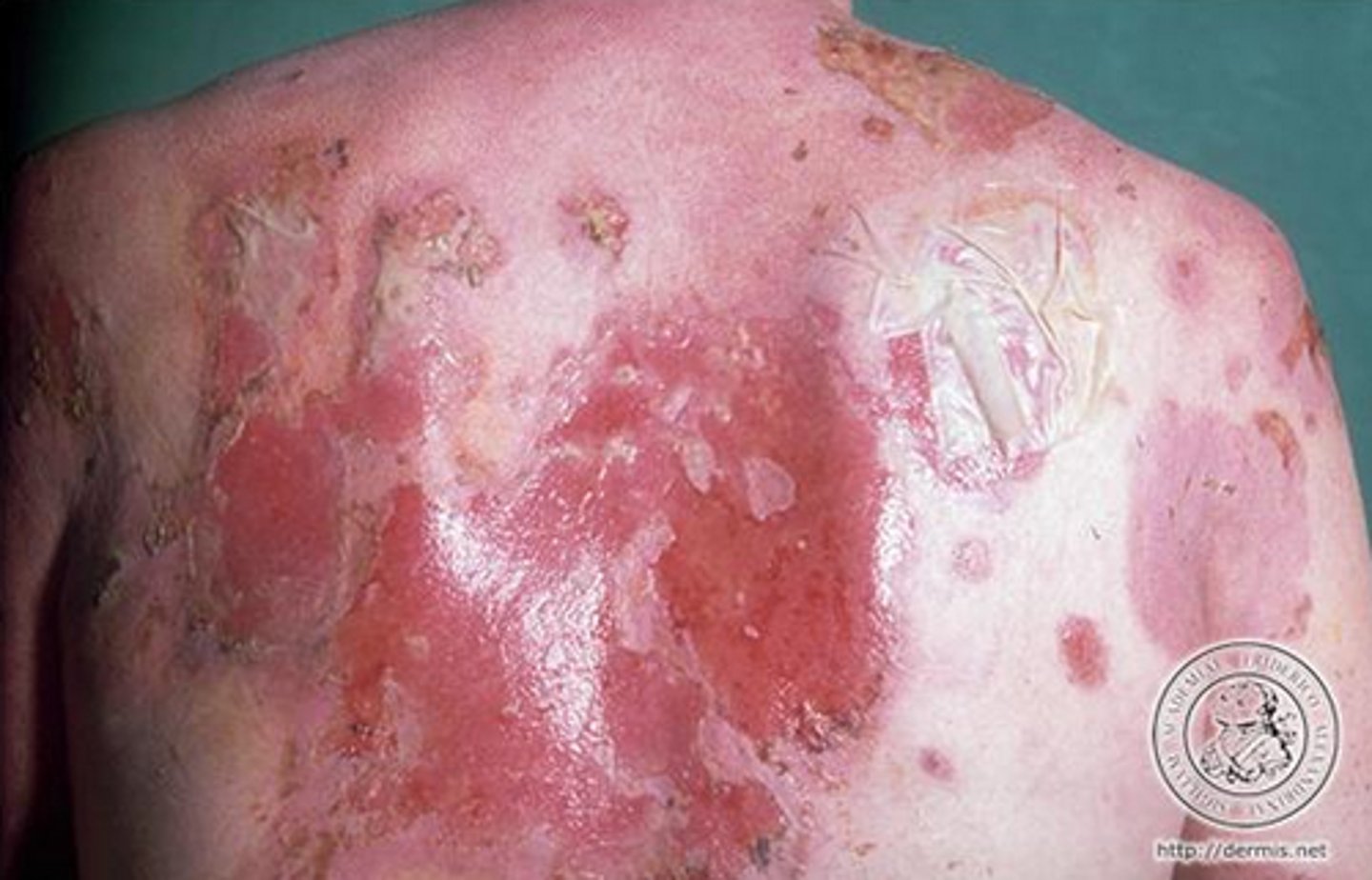 <p>Pemphigus Vulgaris</p>