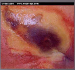 <p>Pressure Injury- Deep Tissue Injury (sDTI)</p>