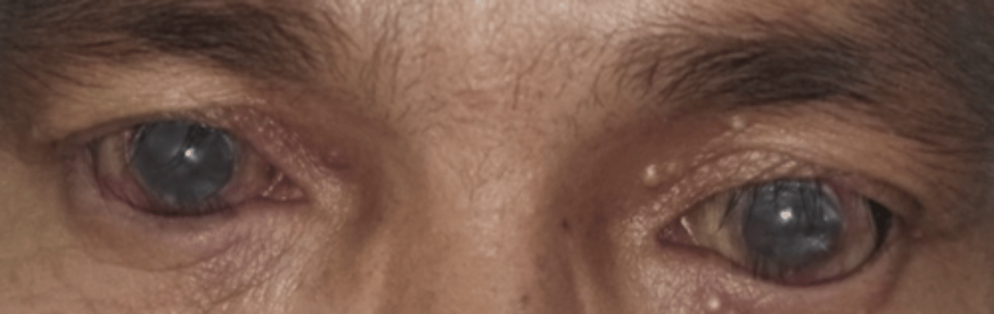 <p>What eyelash condition is this?</p><ul><li><p>&lt;10% of body surface area</p></li></ul><p></p>