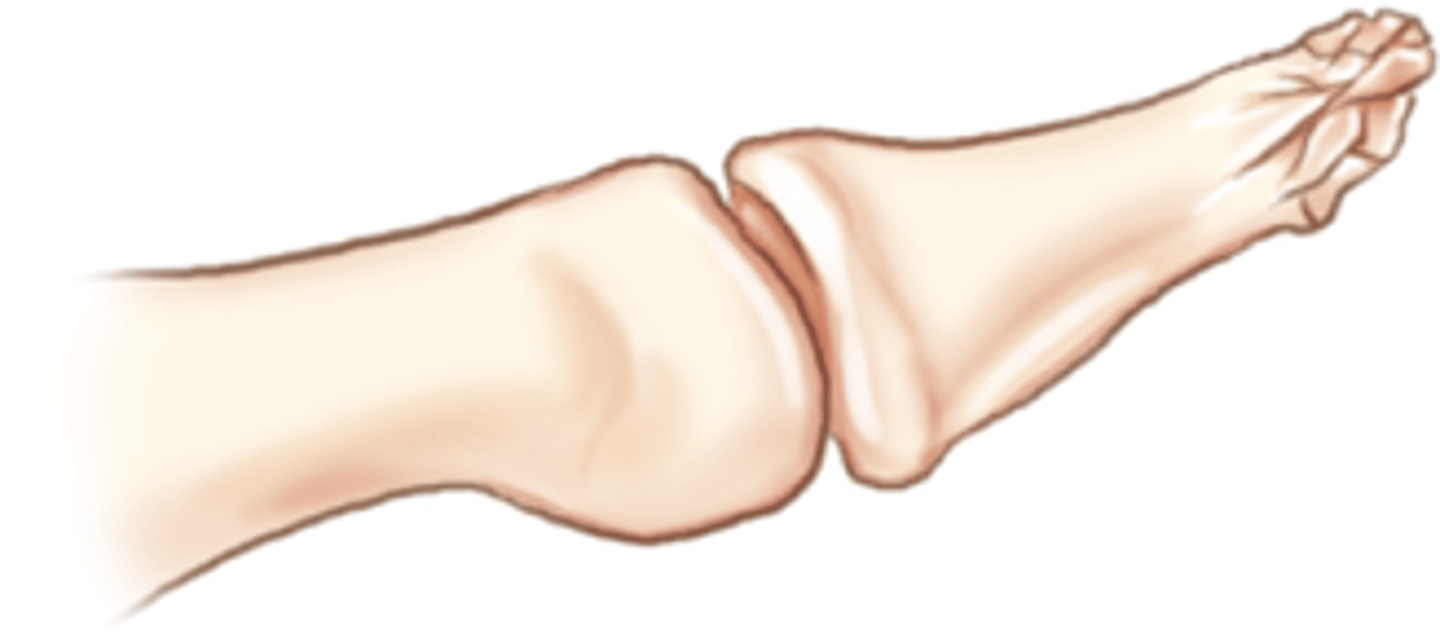 <p>Comminuted fracture of distal phalanx</p>