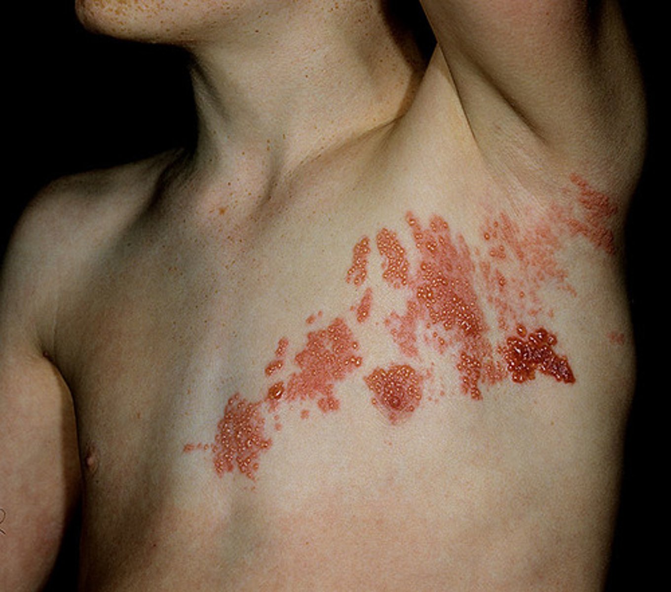 <p>Varicella zoster virus</p>
