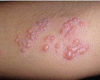 <p><span>Circumscribed elevations of the skin containing clear fluid, &lt;1 cm in diameter</span></p>
