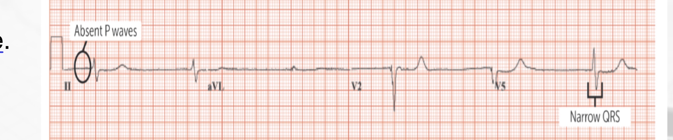 <p>Junctional escape rhythm </p>