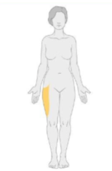 <p>what type of neuropathy would have the following distribution?&nbsp;$</p>