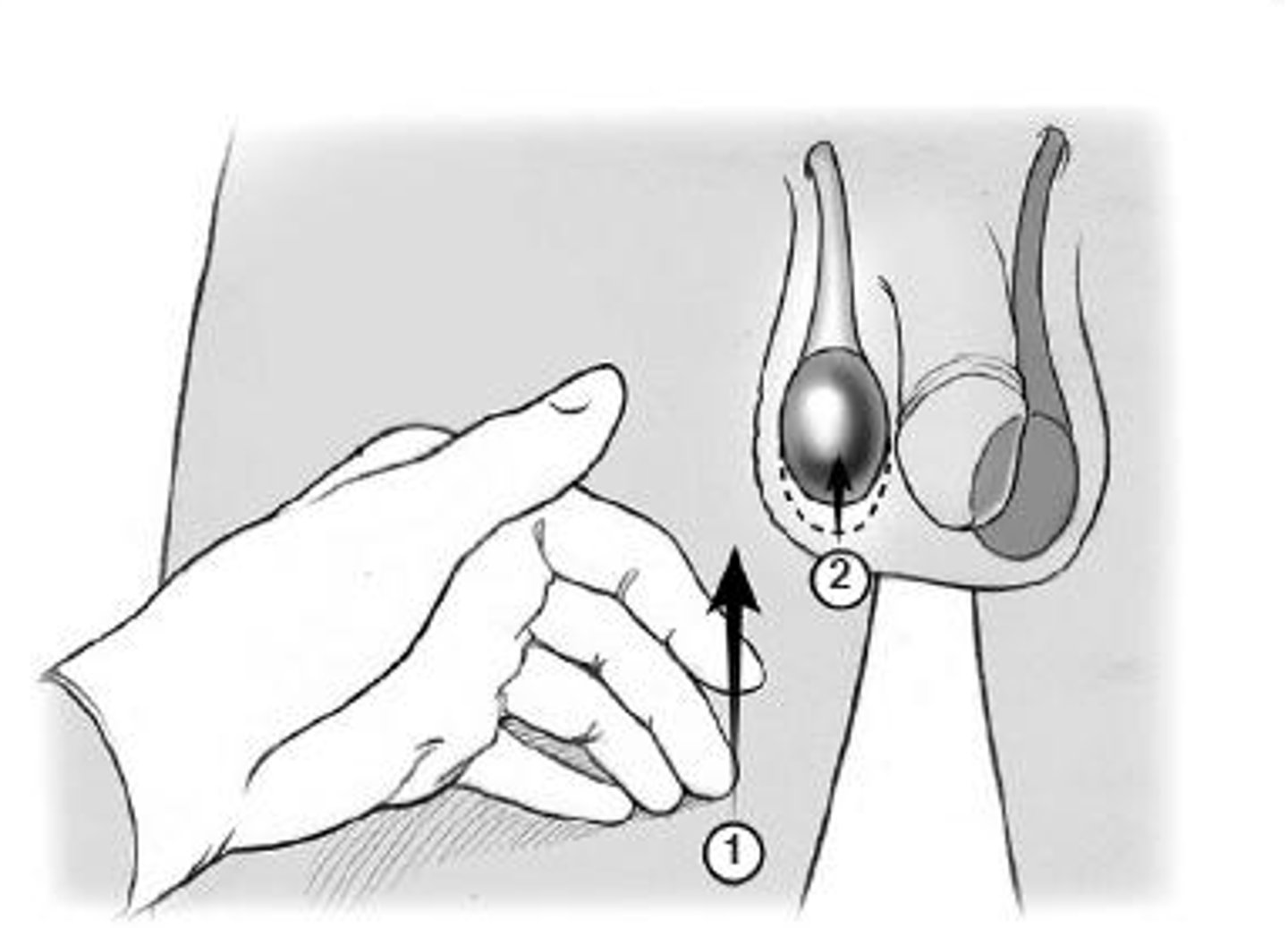 <p>upward pull of testicles and scrotum due to touch</p>