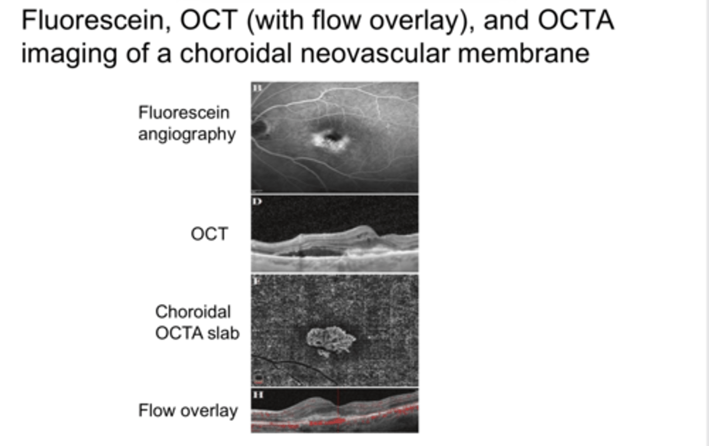 <p>Choroidal Neovasc will be (hyper/hypo)reflective on OCT</p>
