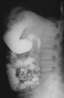 <p>What is this x-ray demonstrating?</p>