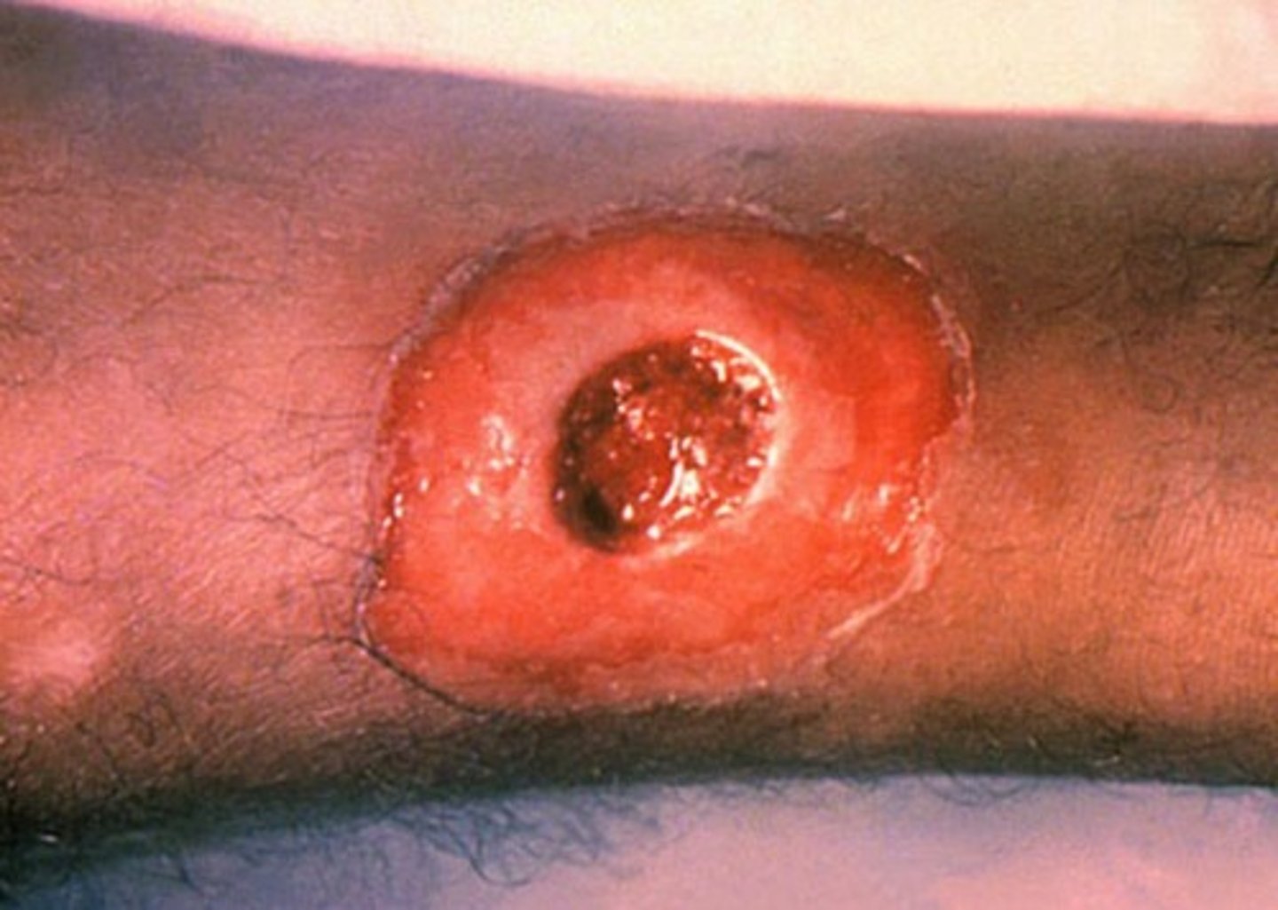 <p>chronic, nonhealing sores or shallow ulcers w/ a dirty gray membrane</p>
