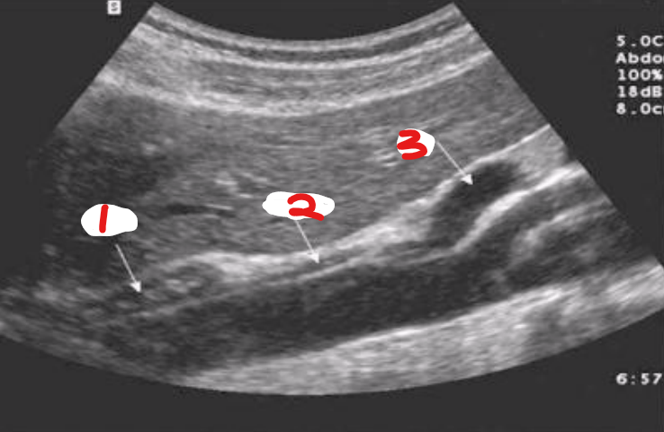 <p>which arrow is pointing to the crus?</p>
