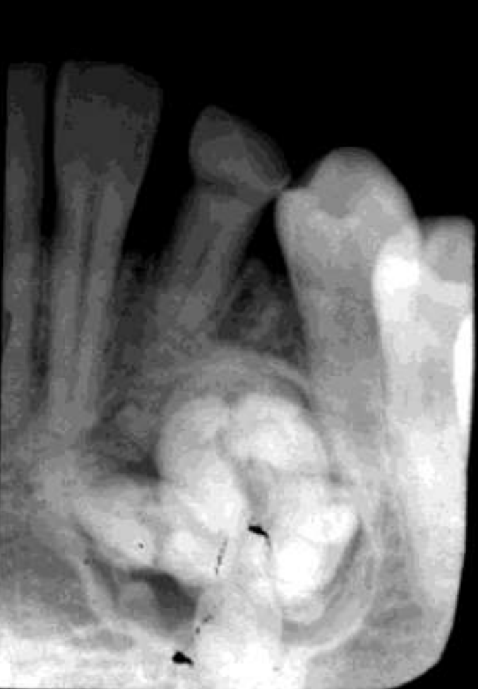 <p>• Well defined, corticated</p><p>• Radiolucent band/soft tissue capsule inside the cortical border</p><p>• Internal content is largely radiopaque</p><p>• Maybe associated with unerupted tooth</p>