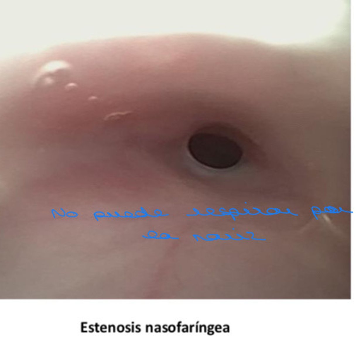 <p>-obstrucción causada por tejido cicatricial entre la nasofaringe y la orofaringe</p><p>- impide que el aire fluya con normalidad</p>